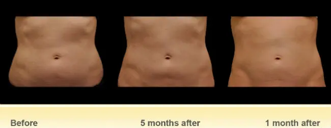 CoolSculpting Before and After Pictures Pflugerville, TX