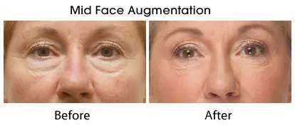 mid-face-augmentation