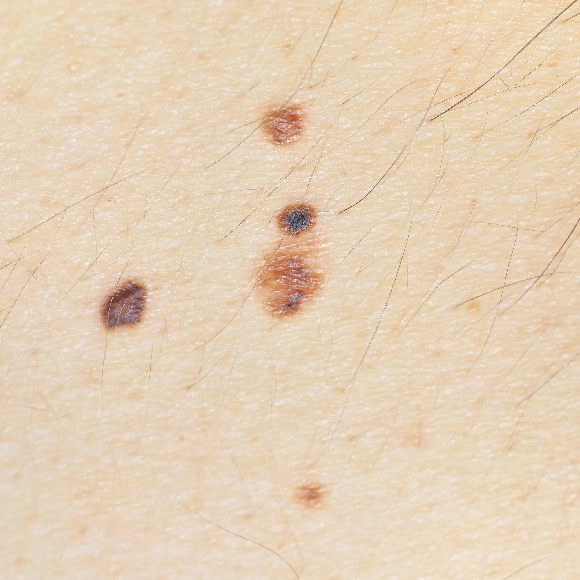 Colorectal Cancer | Colon Cancer | Rectal Cancer | MedlinePlus, image size:2000x2000