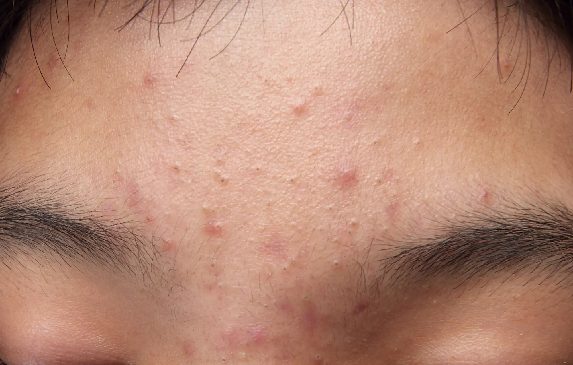 Benefits Of Low Dose Accutane, image size:2000x1272