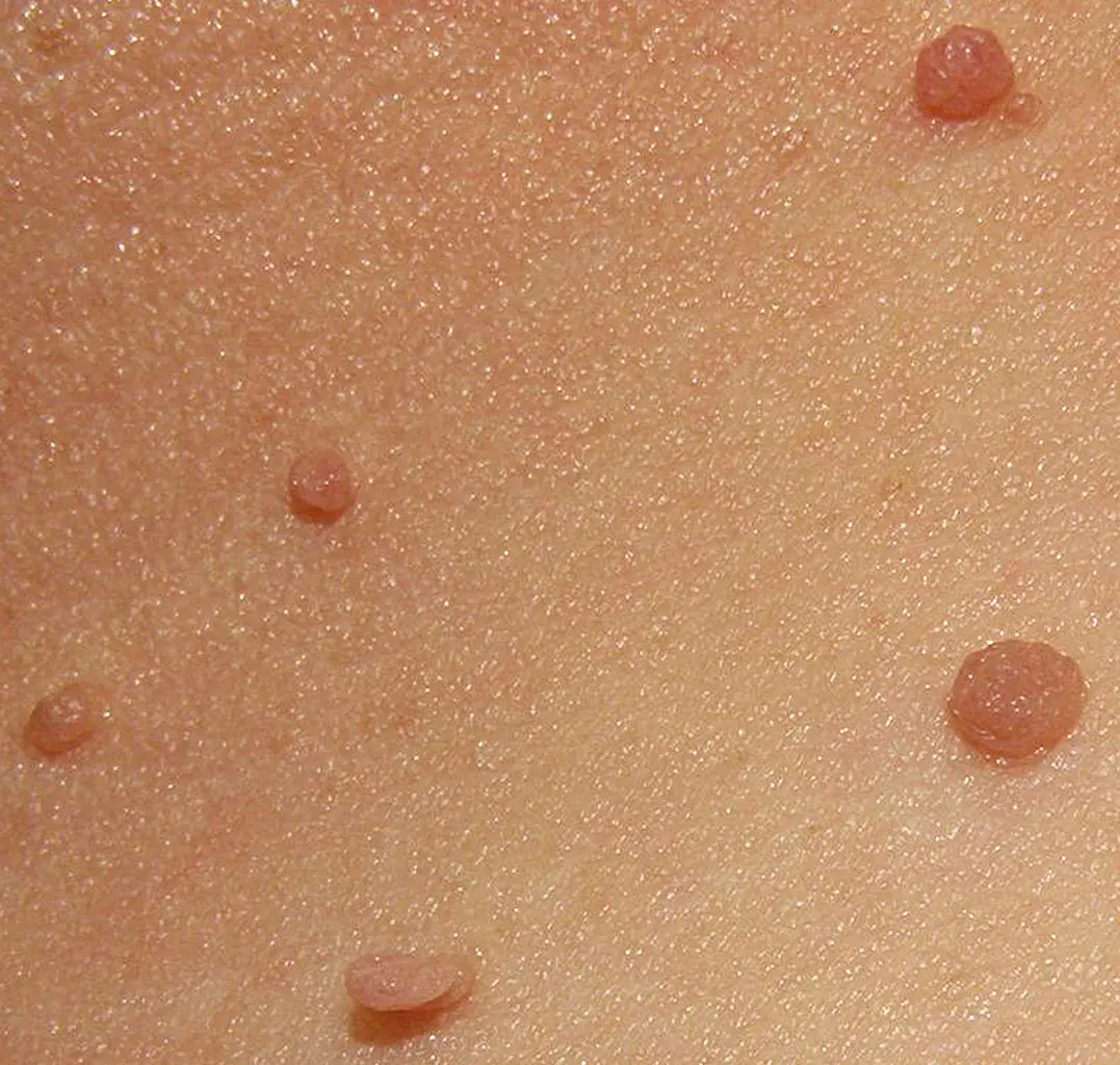 Skin Tags Treatment in Austin, TX