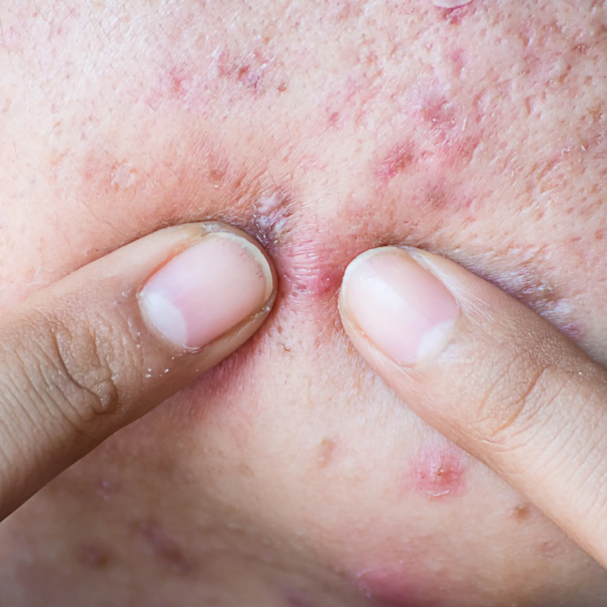 Top 4 Cystic Acne Treatments, image size:2000x2000