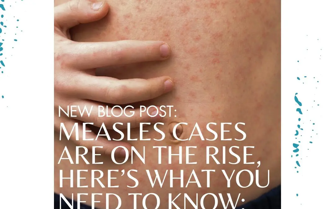 Measles Cases Are on the Rise, Here’s What You Need to Know: