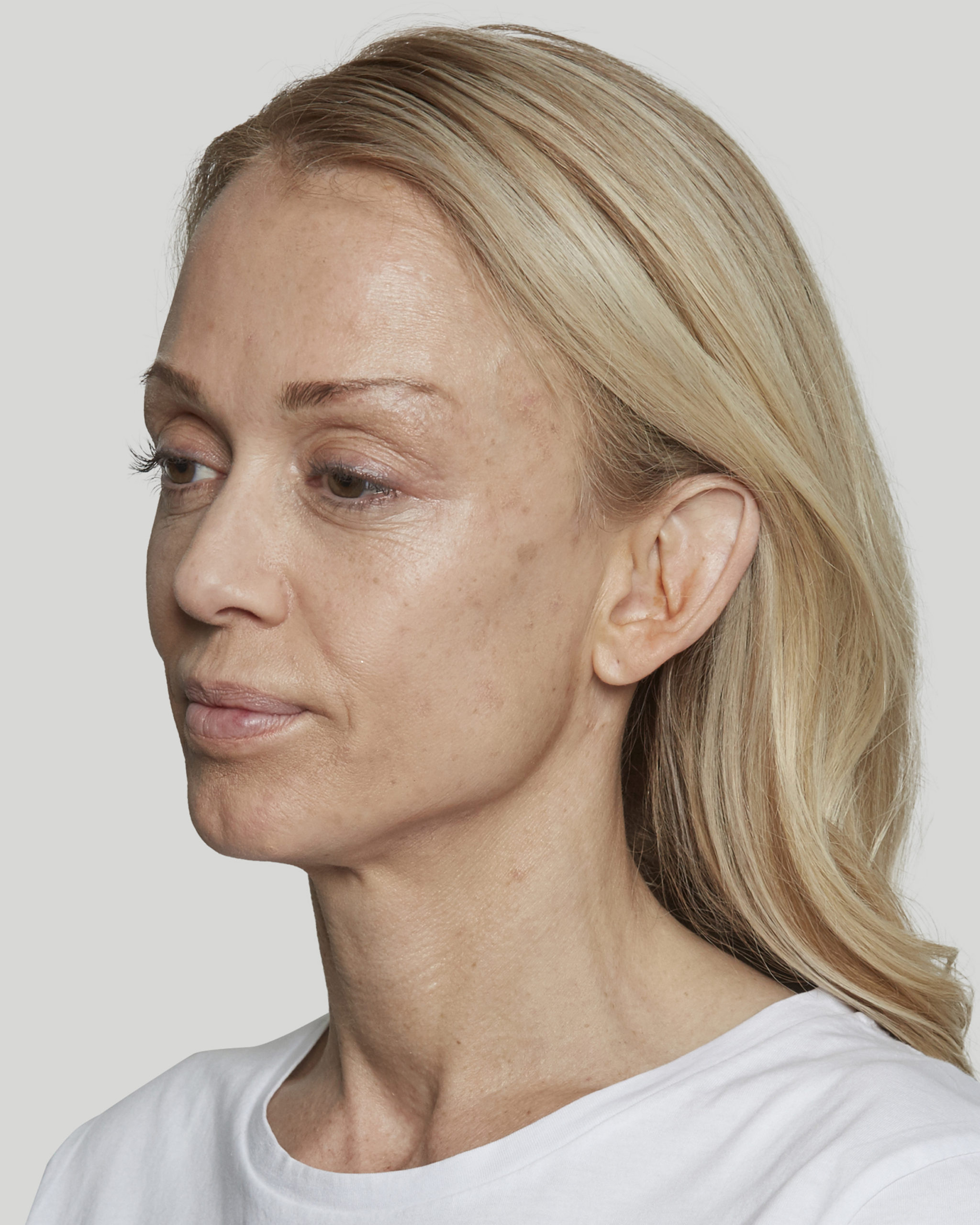 Anna after 1 Q left2 Sculptra Before and After Pictures Pflugerville, TX