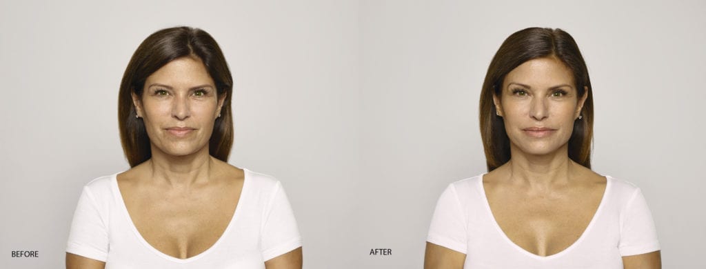 Restylane Before and After Pictures Pflugerville, TX