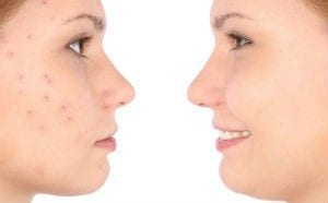 acne2-300x200