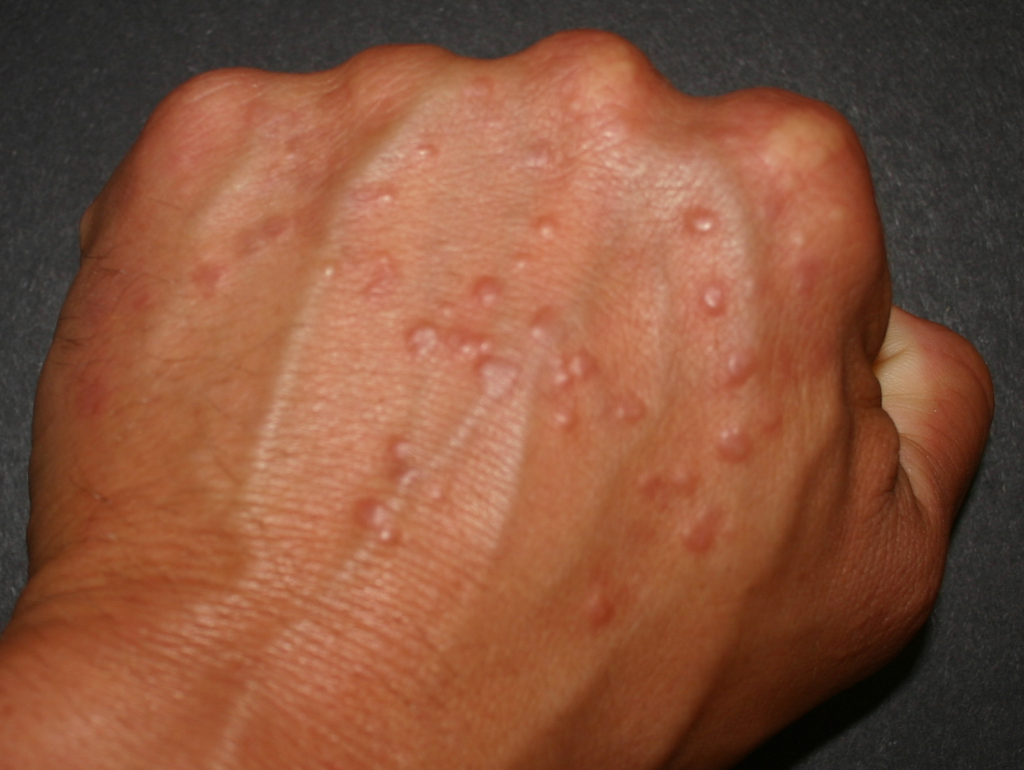 rashes on hands and arms