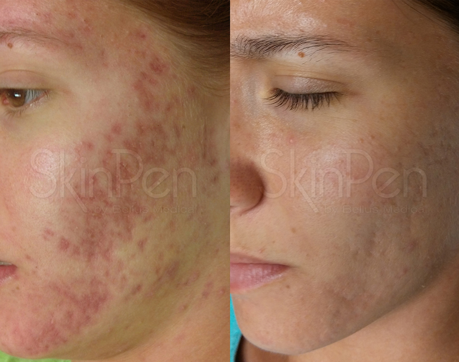 b-a-slide15 copy Microneedling for Skin Rejuvenation in Pflugerville, TX
