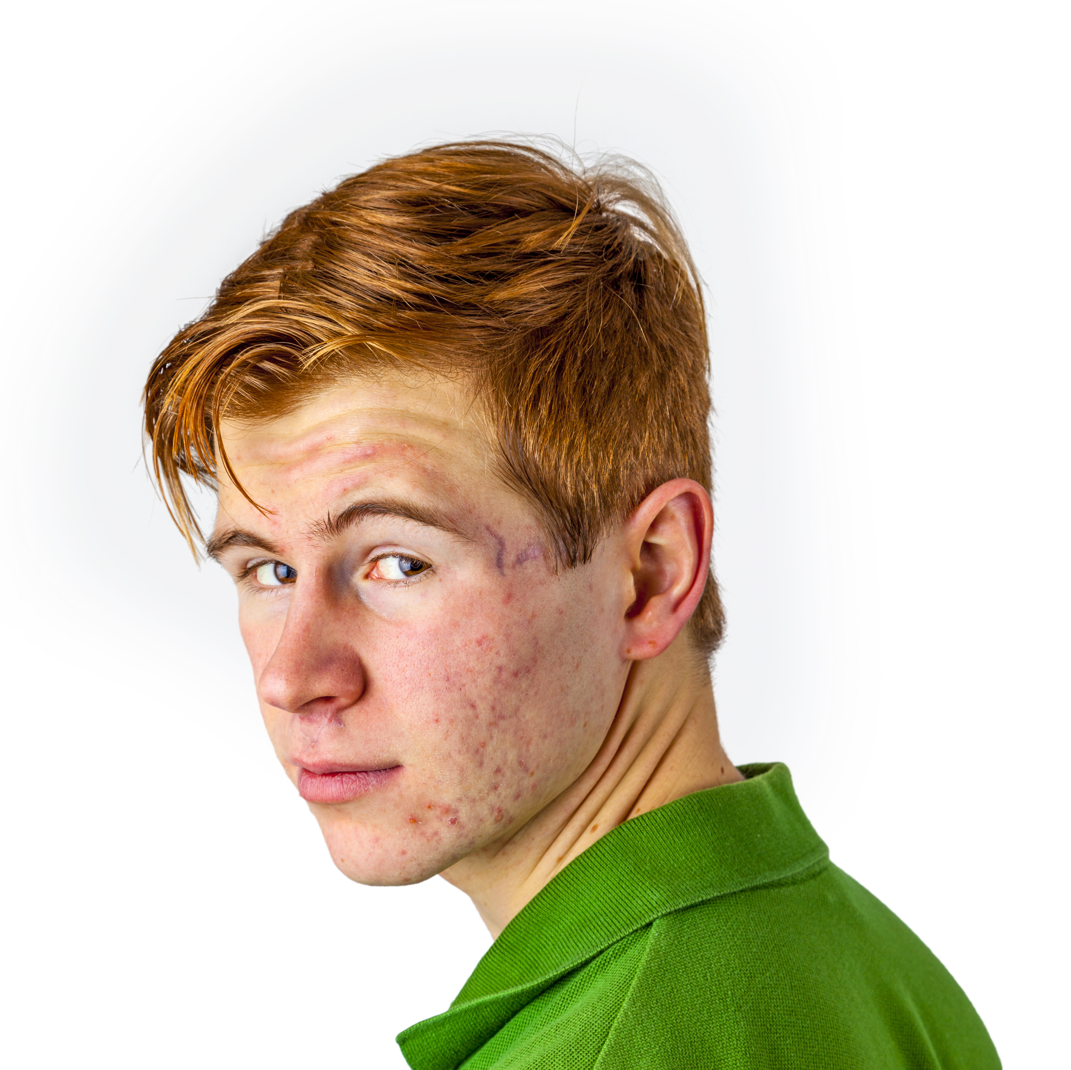Microneedling for Acne Scars in Texas & Louisiana