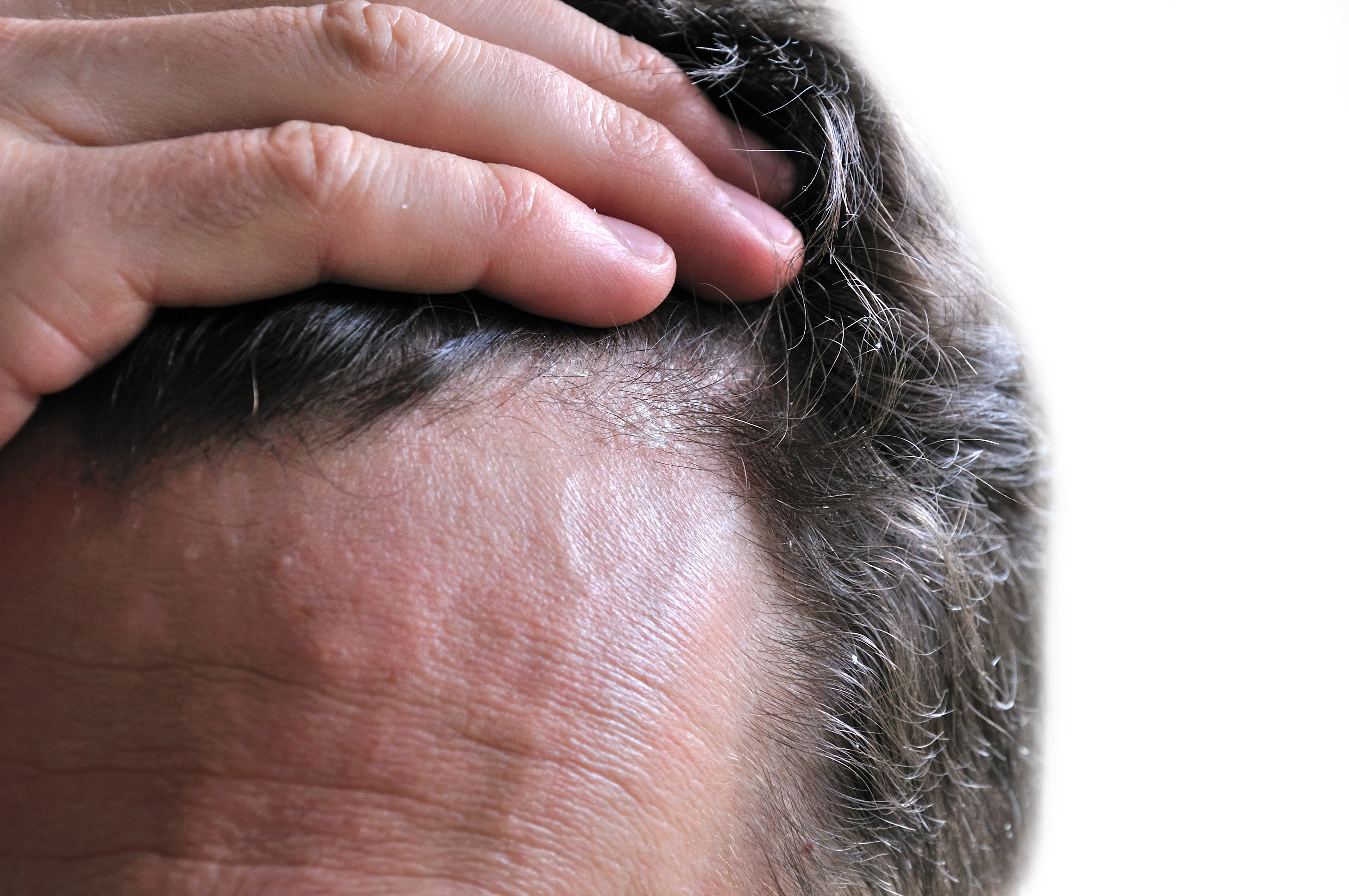 Seborrheic