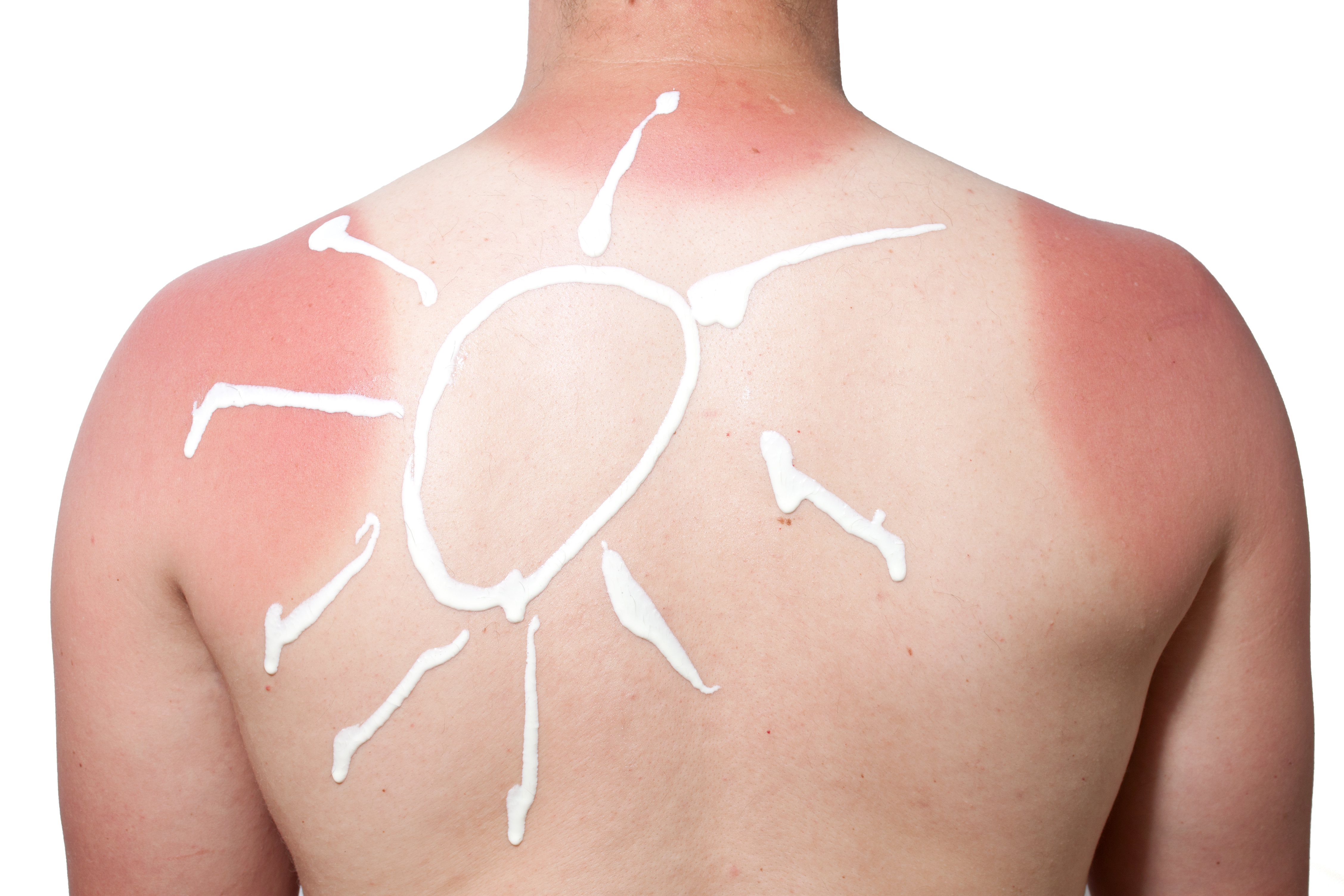 Sunburn