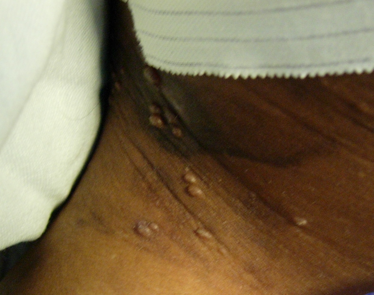 Molluscum