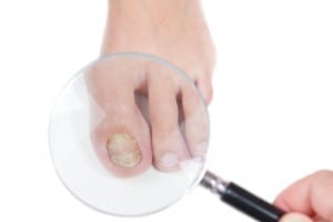 Doctor dermatologist examines the nail on the presence of the fu