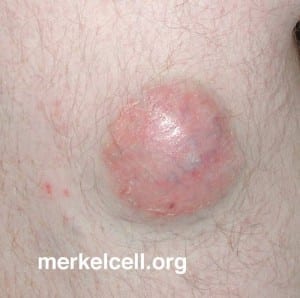 image courtesy of merkelcell.org