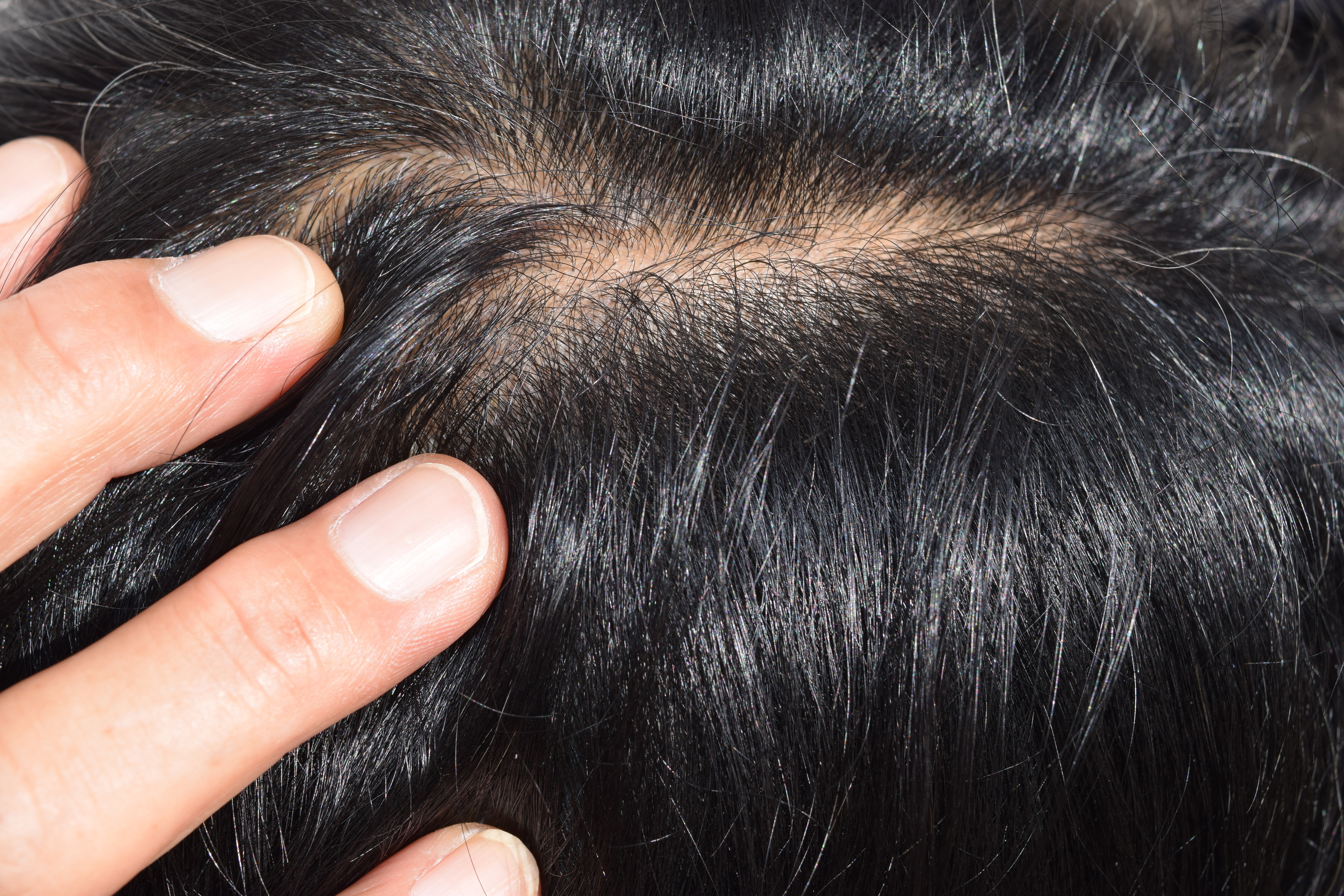 What Is a Pilar Cyst?