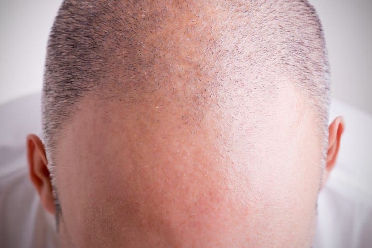 Hair Loss Sanova Dermatology