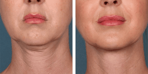 Kybella-f-1