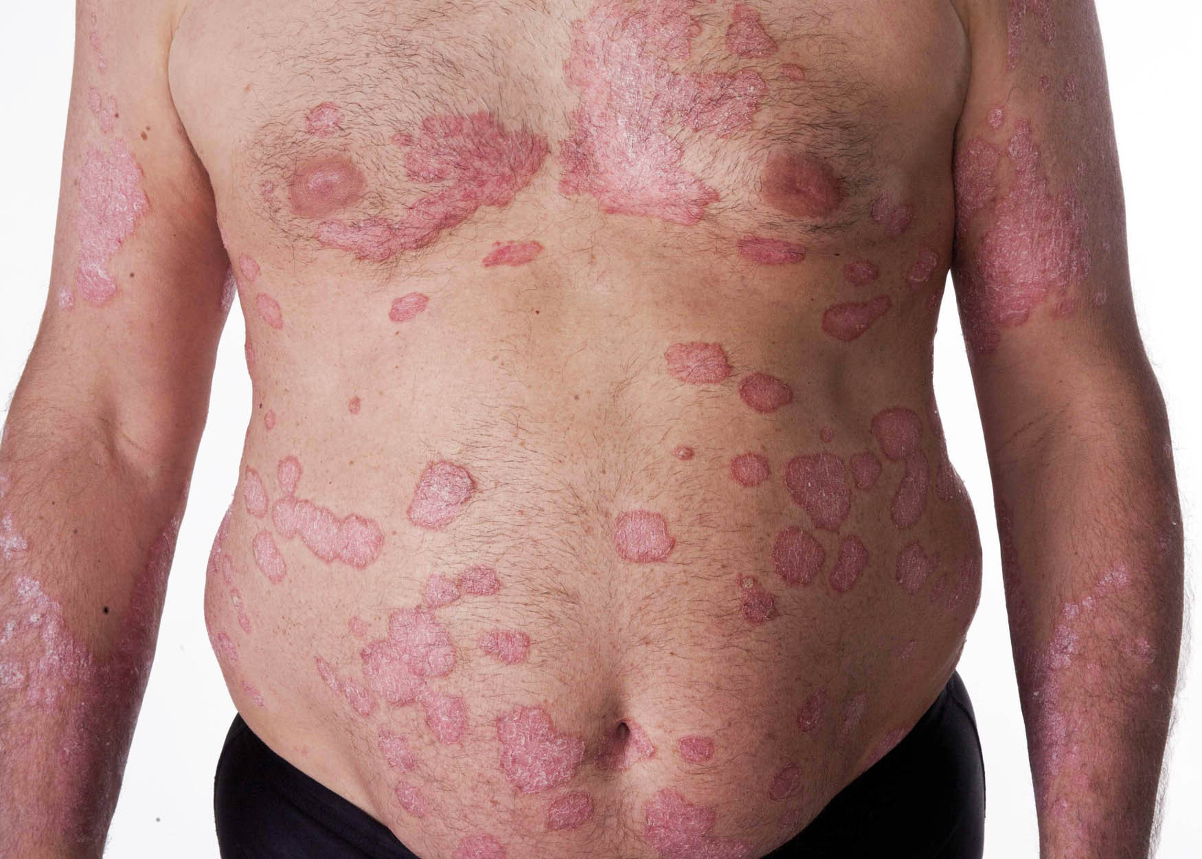 Psoriasis Treatment in Austin, TX