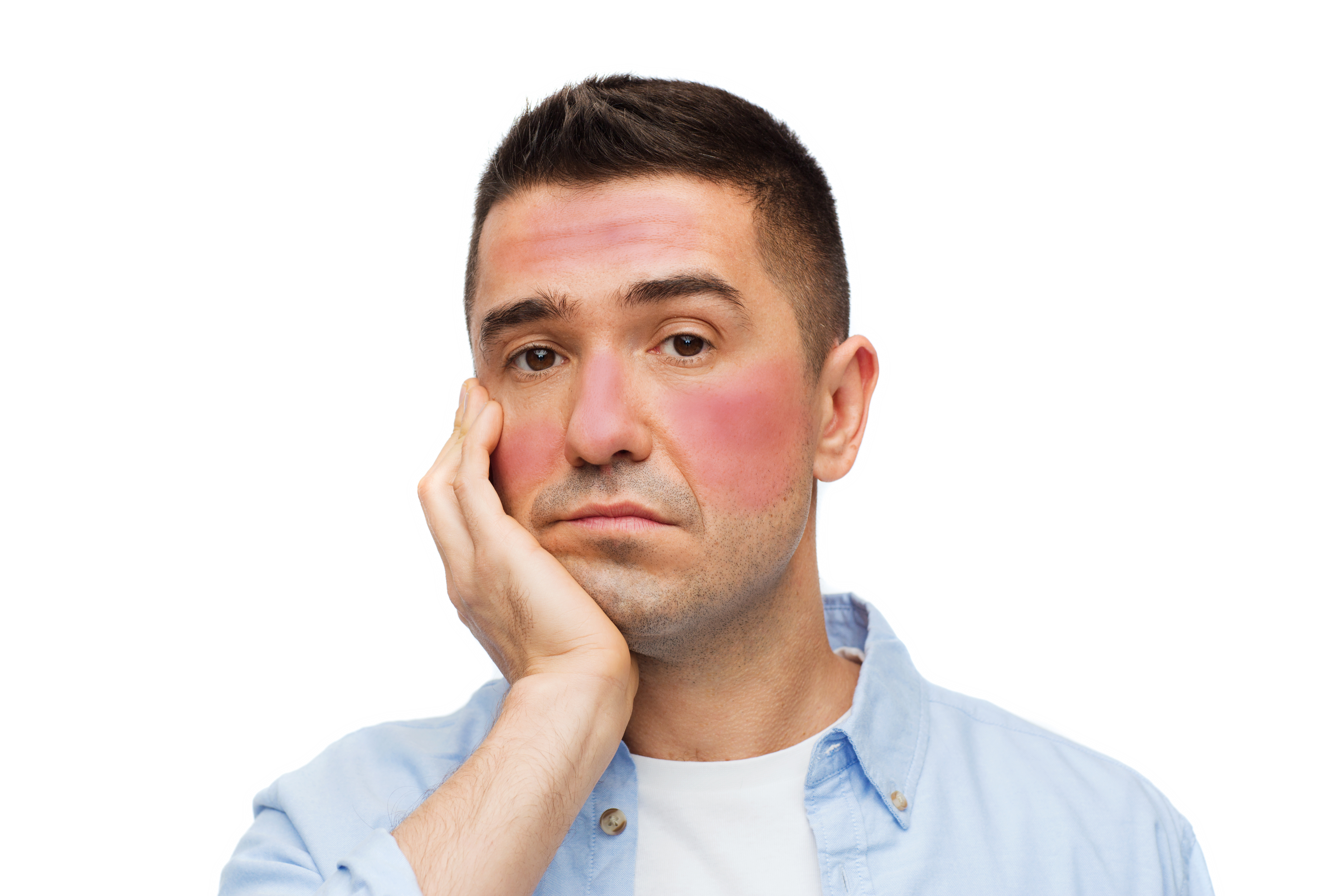 Rosacea