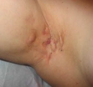 Hidradenitis-suppurativa-Image