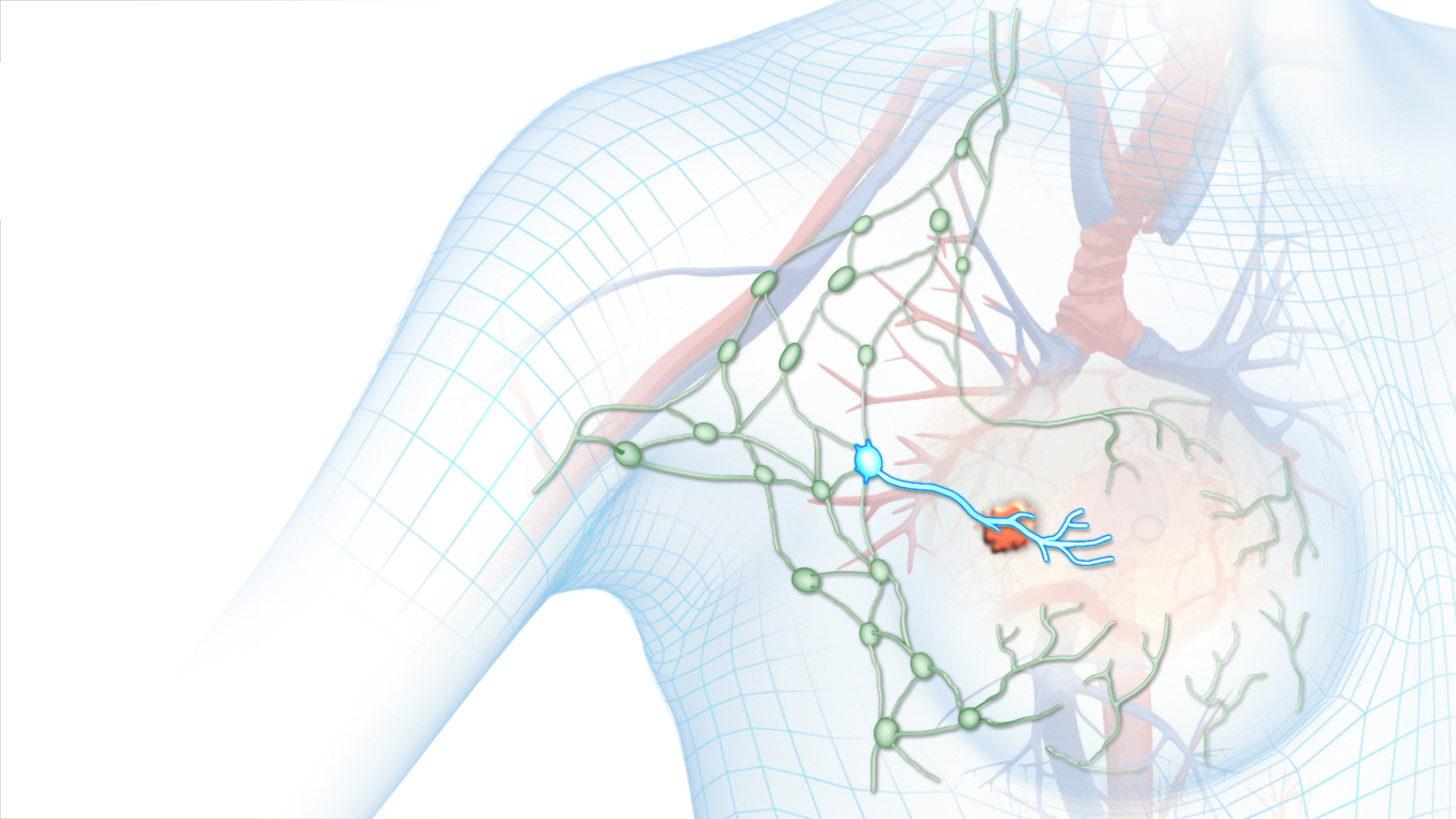 What Is A Sentinel Lymph Node Biopsy and When Is It Recommended For Skin Cancer?