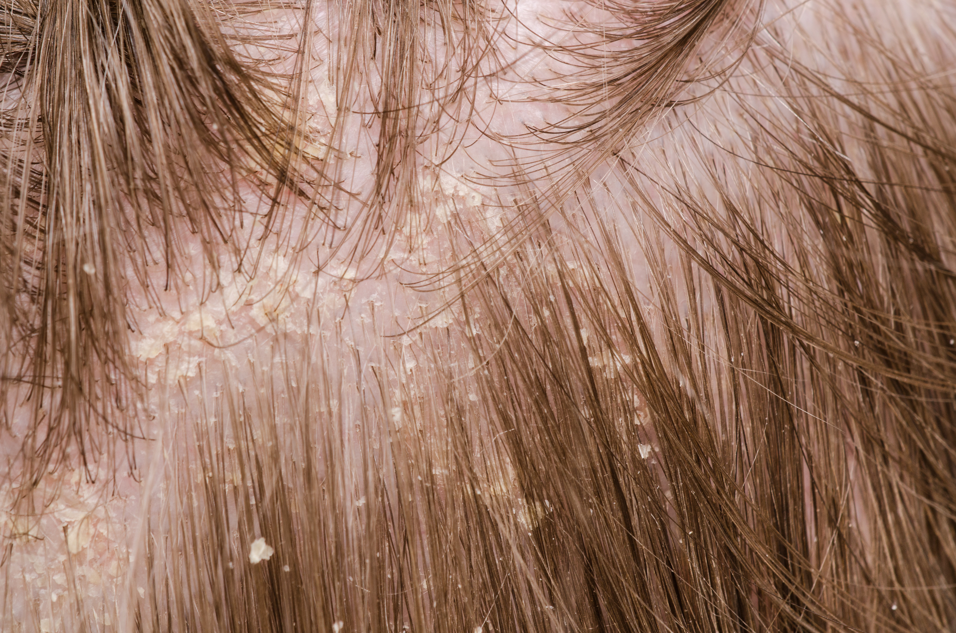 Seborrheic