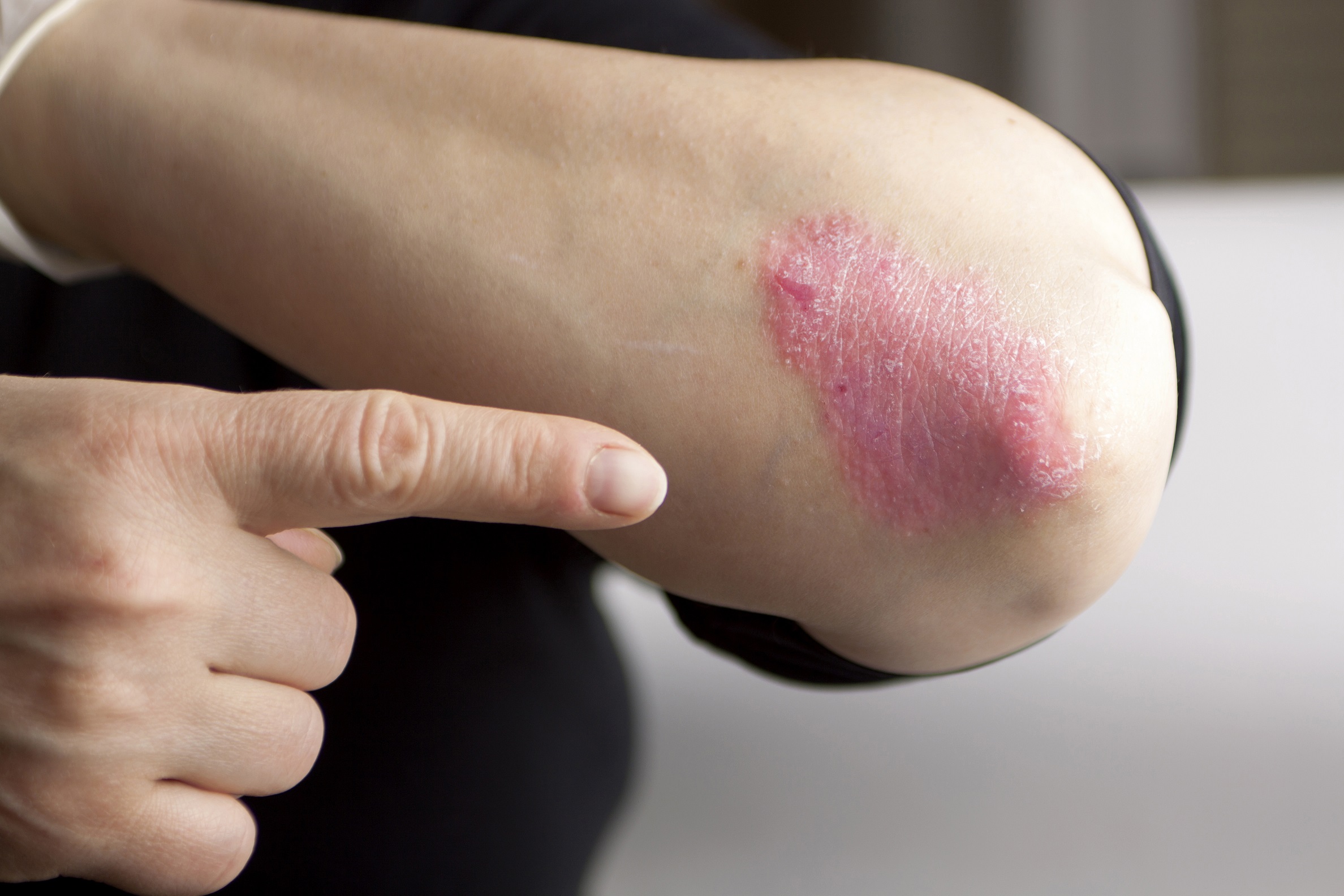 What is Atopic Eczema?