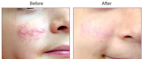 bna-scar