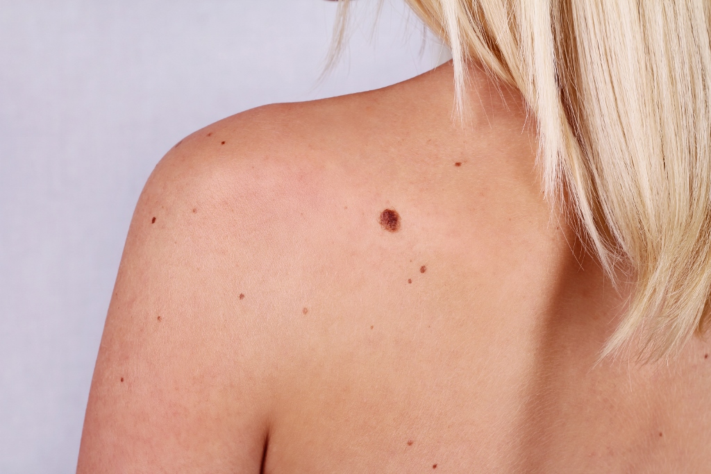Skin Cancer: This New Year, Make Sure You Get Checked