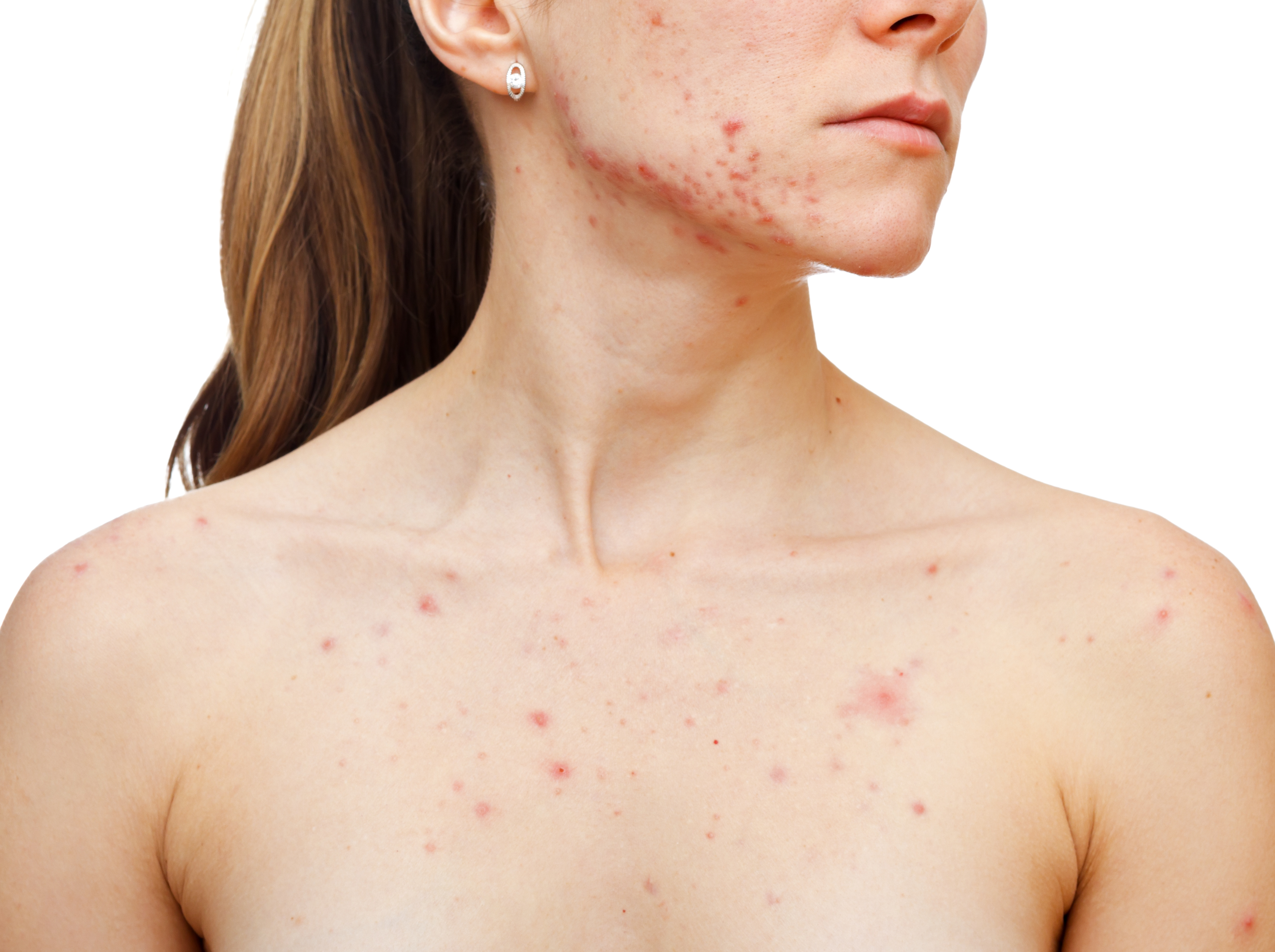 How Acne and Polycystic Ovarian Syndrome Are Connected