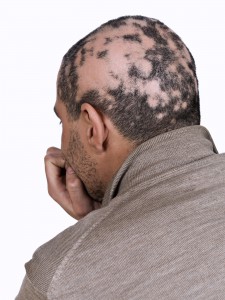Alopecia