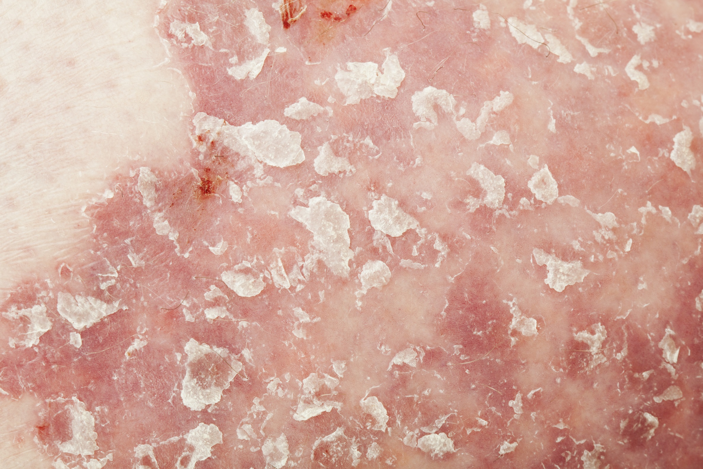 How do I Know if my Eczema is Infected?