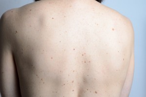 Melanoma