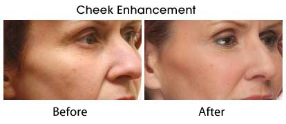 JUVÉDERM VOLUMA® XC