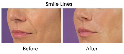 Radiesse® in Pflugerville, TX