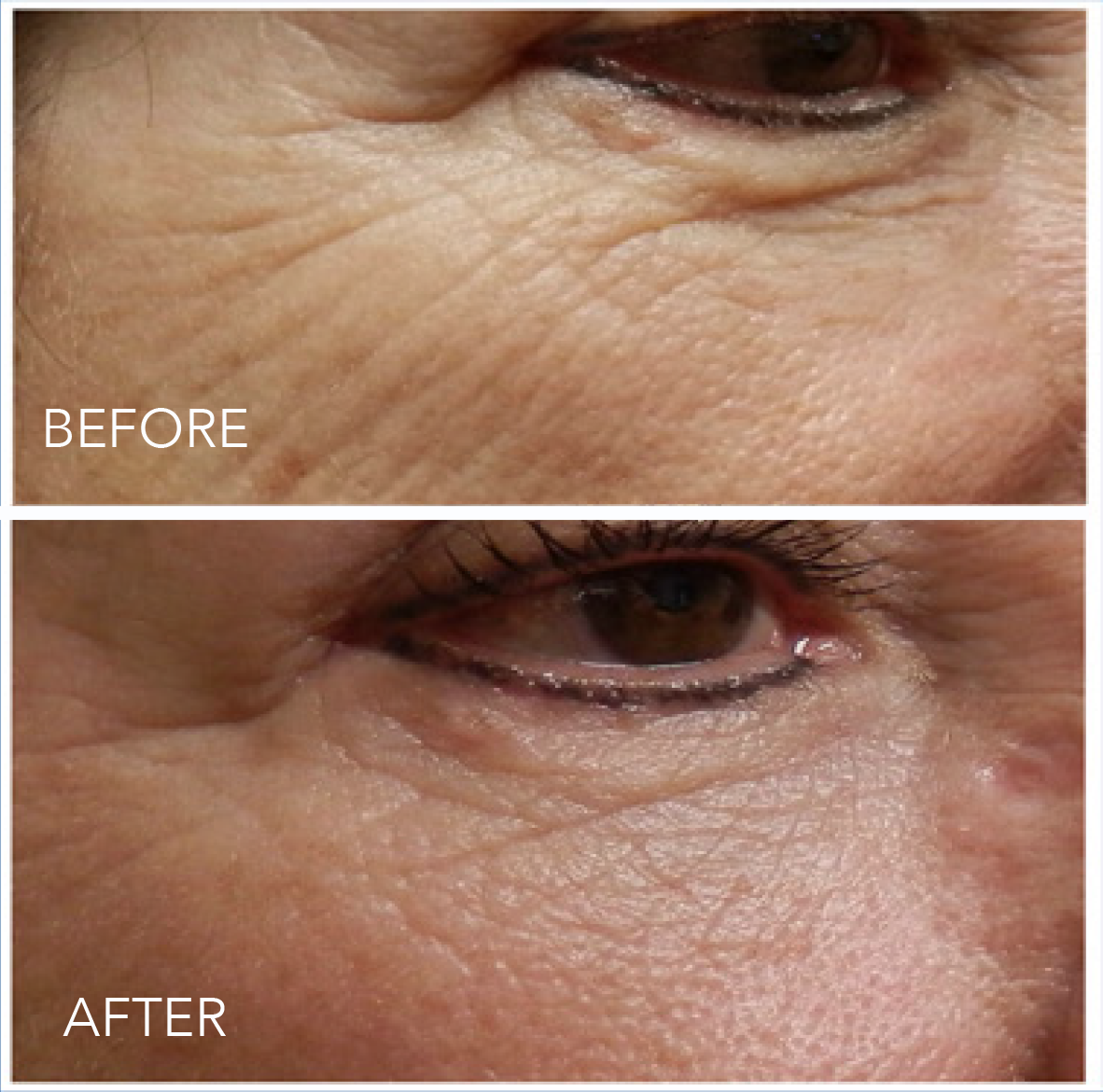 Can Micro-Needling Help You Look Less Tired?