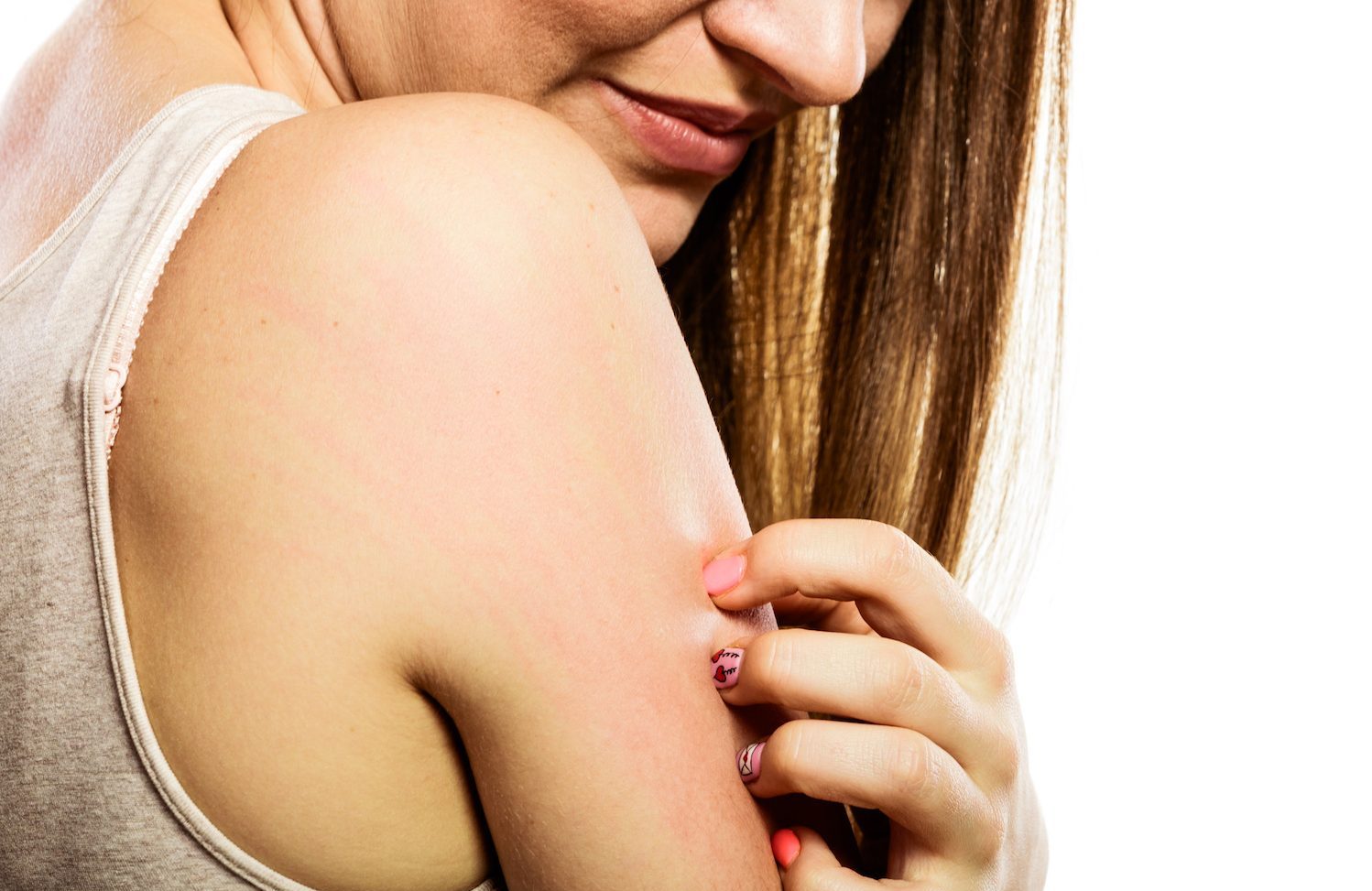 Top 3 Treatments for Keratosis Pilaris