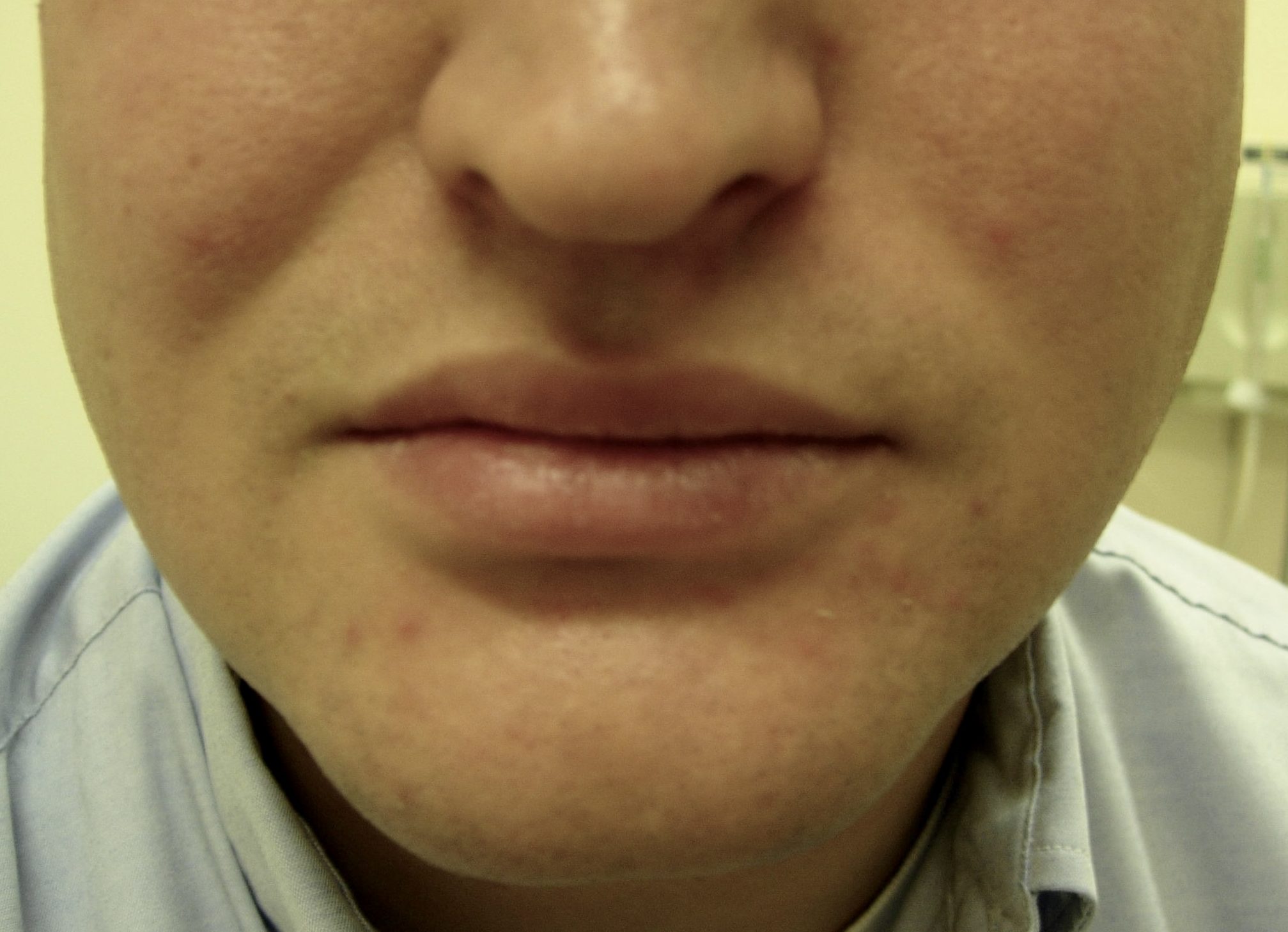 Perioral
