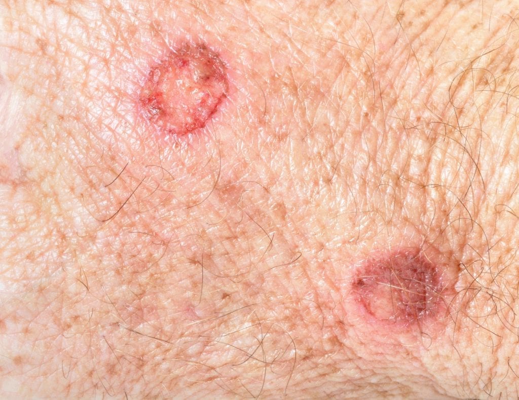 Causes and Risks of Basal Cell Carcinoma 