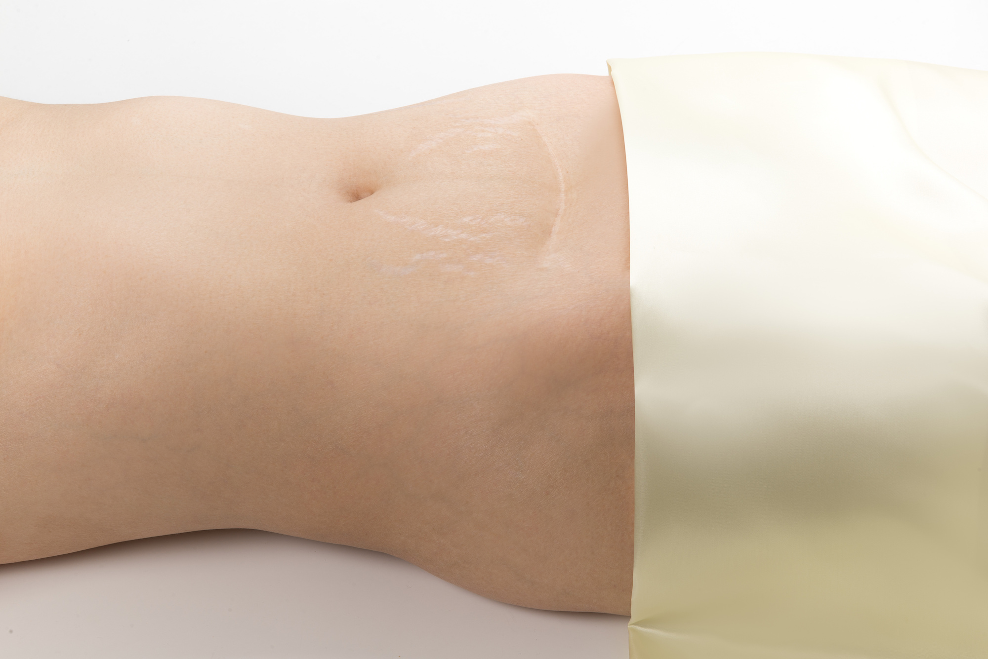 Sublative Skin Resurfacing For Stretch Marks