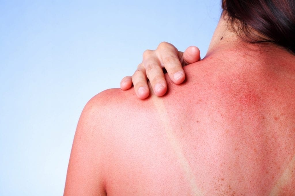 Sunburns Increase Your Risk For Skin Cancer