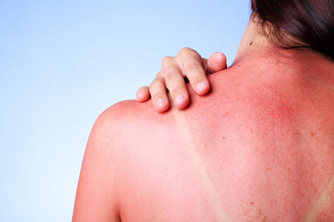 How do sunburns increase your risk of skin cancer?