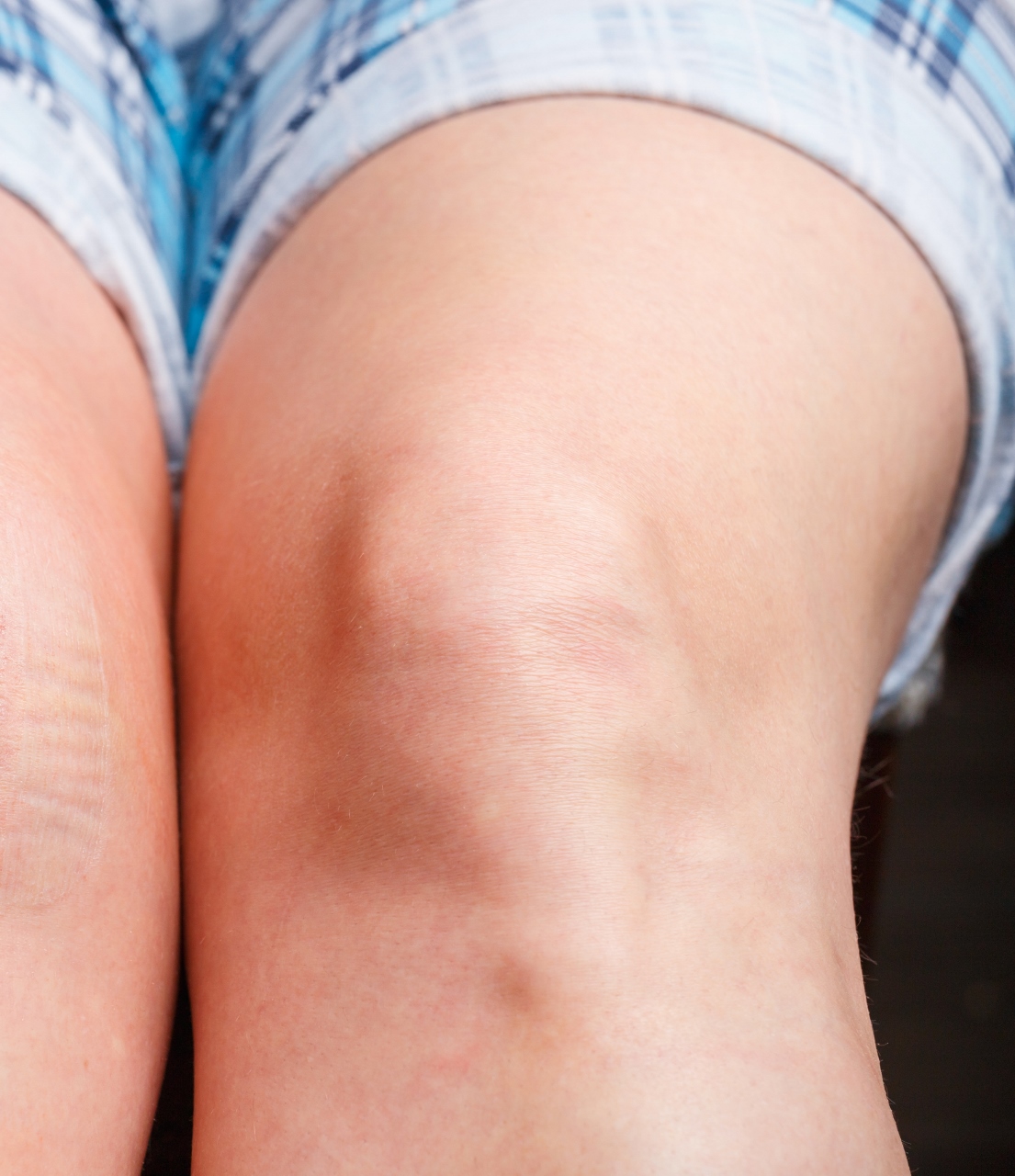 What Therapies are Available to Treat Dark Elbows and Knees?
