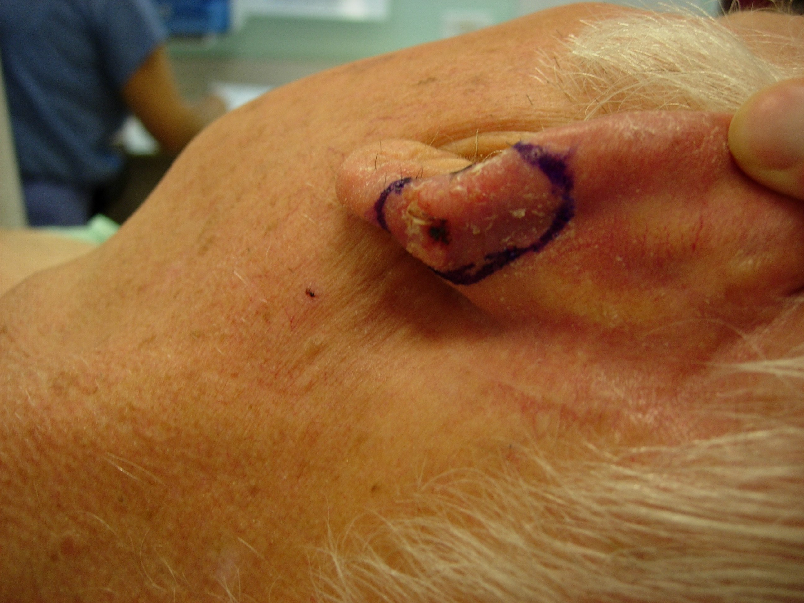 Squamous