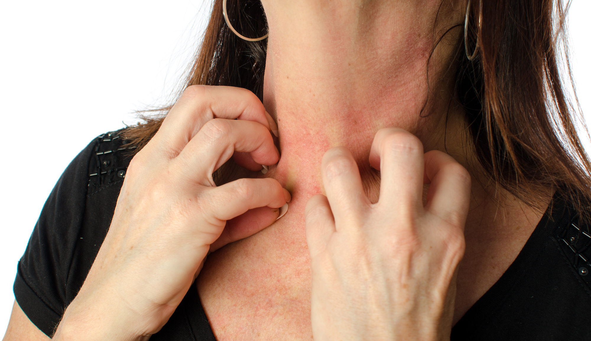 Eczema