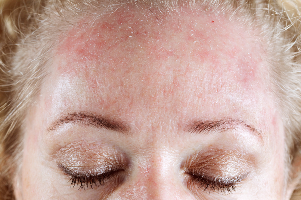 Rosacea Treatment in Austin, TX