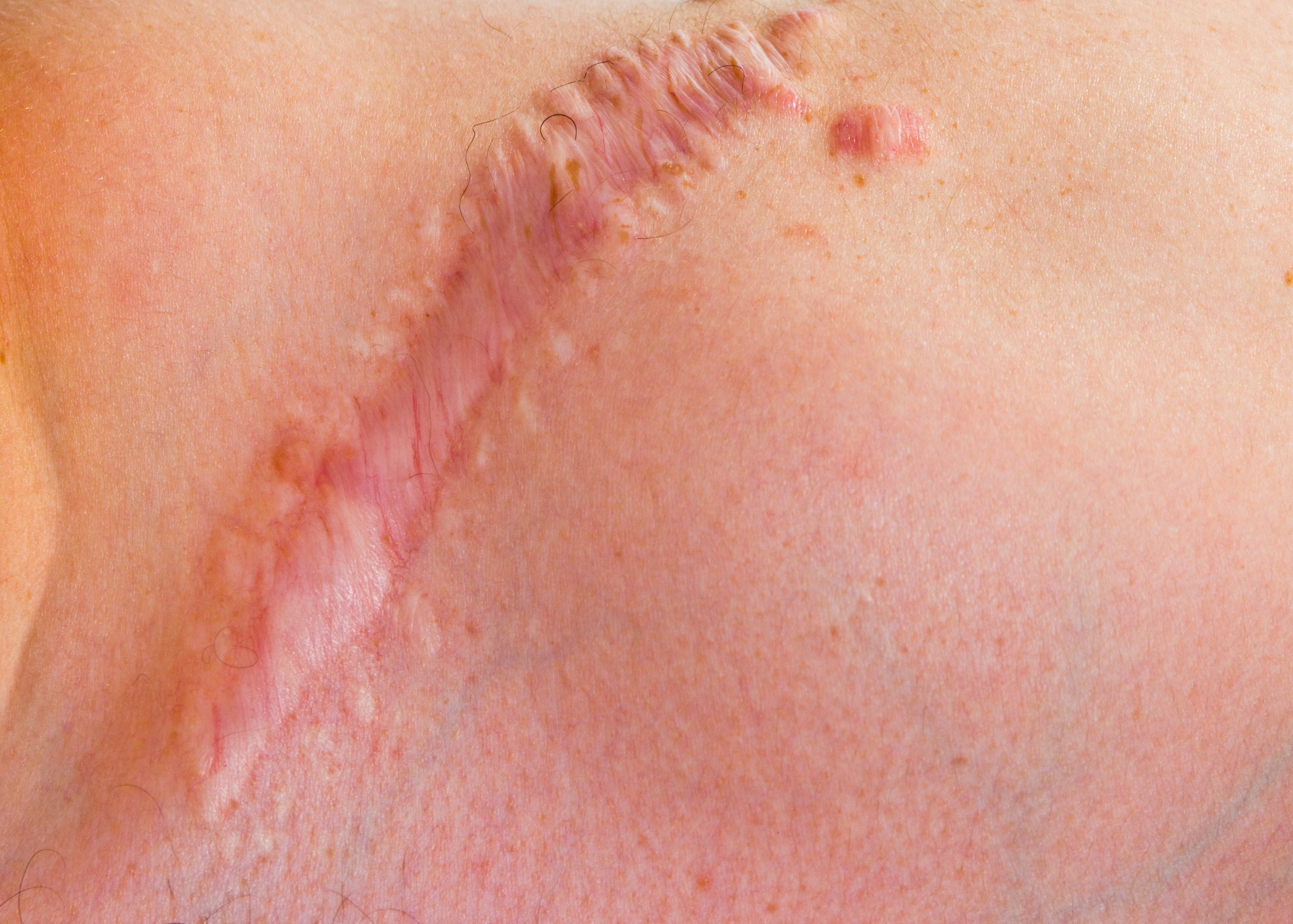 Minachting Vermenigvuldiging diepte Pulse Dye Laser For Surgical & Hypertrophic Scars