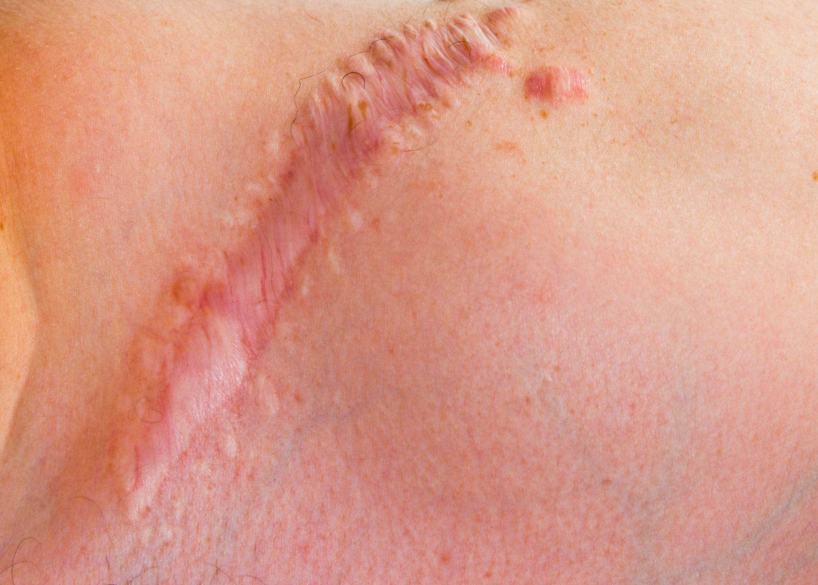 Pulse Dye Laser in Austin, TX