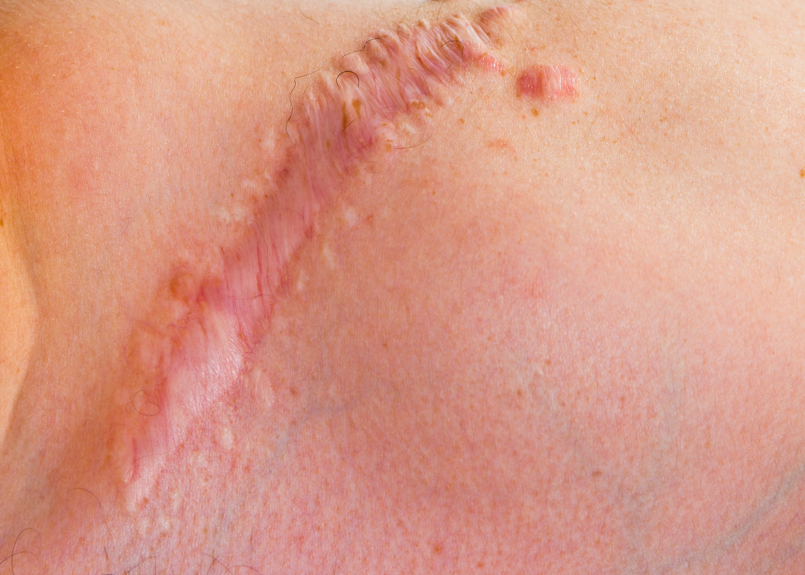 How Can Pulse Dye Laser Improve Surgical and Hypertrophic Scars?