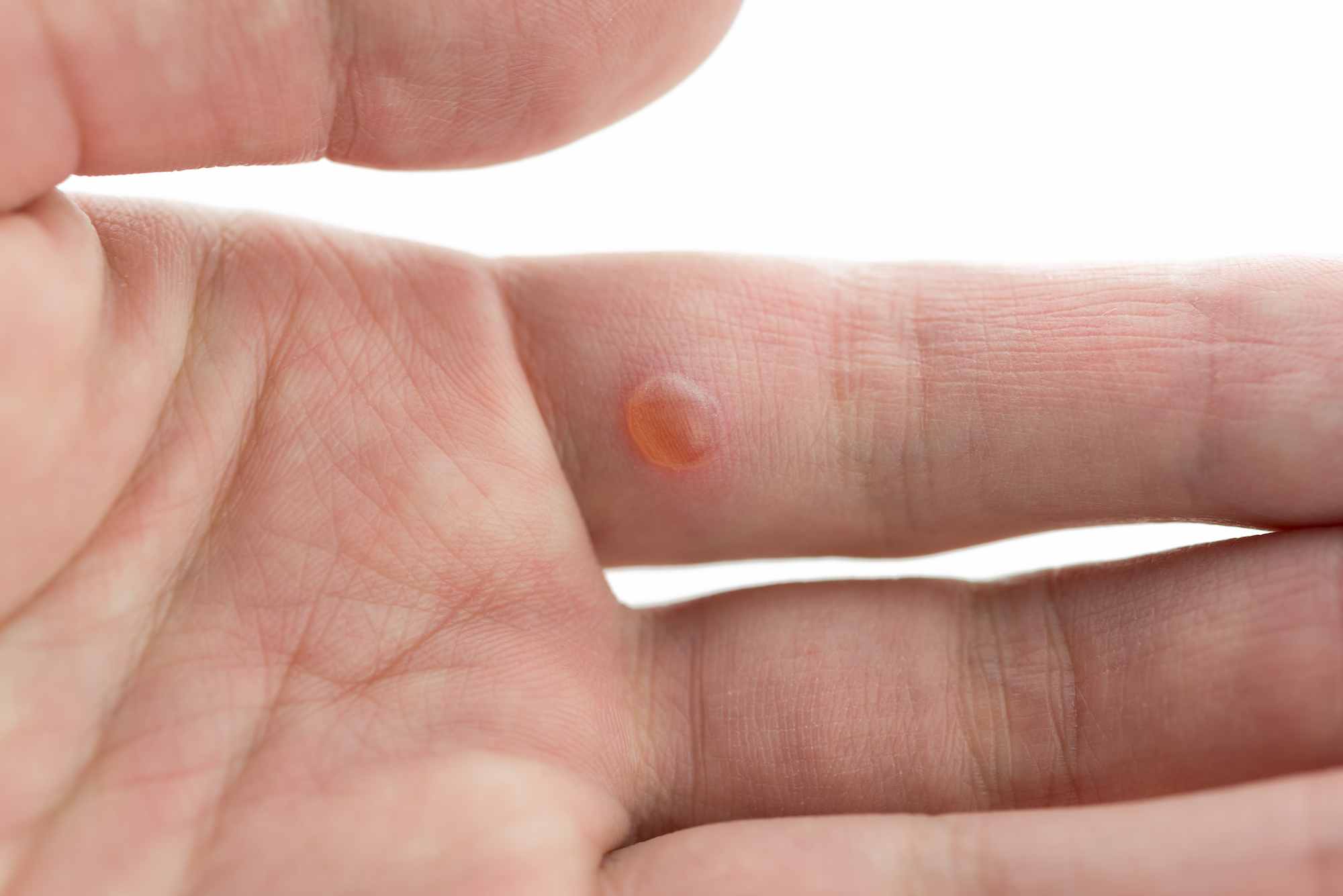 Warts Treatment in Austin, TX